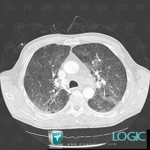 Pneumonie interstitielle aiguë, Parenchyme pulmonaire, Scanner