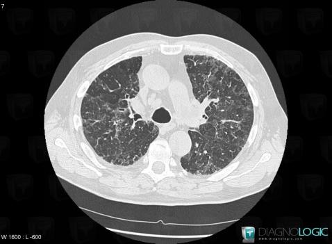 Pneumonie interstitielle desquamative, Parenchyme pulmonaire, Scanner