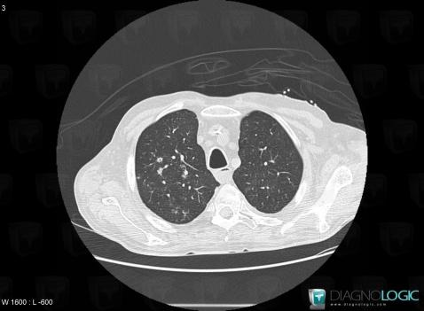 Pneumonie-pseudomonas, Parenchyme pulmonaire, Scanner