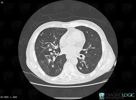 Pneumonie-pseudomonas, Parenchyme pulmonaire, Scanner