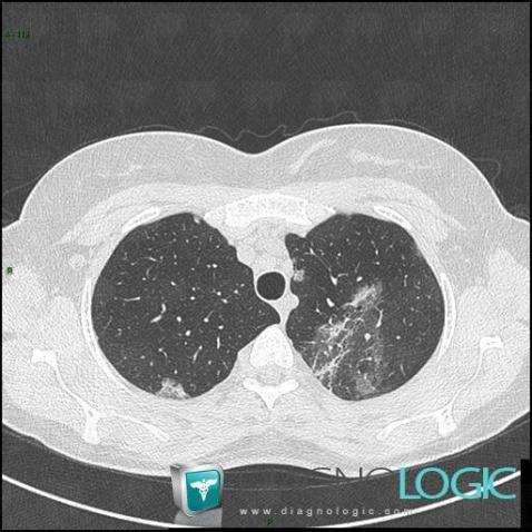 Pneumopathie chronique-éosinophile, Parenchyme pulmonaire, Scanner