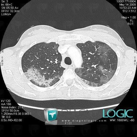 Pneumopathie chronique-éosinophile, Parenchyme pulmonaire, Scanner