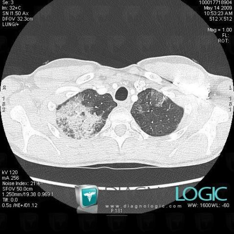 Pneumopathie chronique-éosinophile, Parenchyme pulmonaire, Scanner