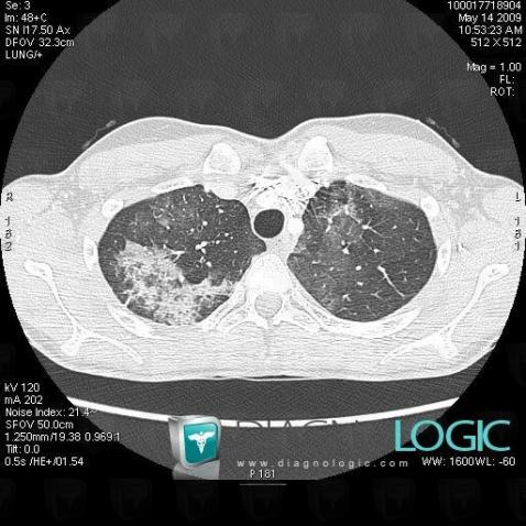 Pneumopathie chronique-éosinophile, Parenchyme pulmonaire, Scanner