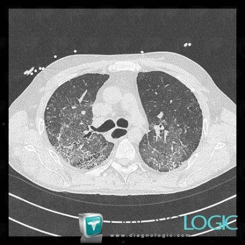 Pneumopathie d'origine médicamenteuse, Parenchyme pulmonaire, Scanner