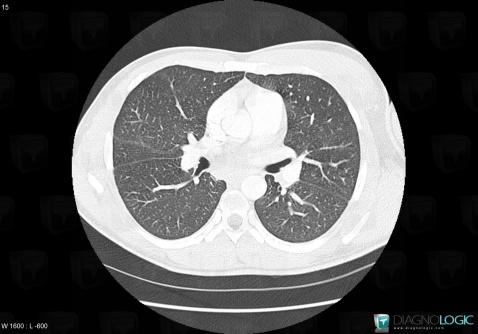 Pneumopathie interstitielle lymphoïde, Parenchyme pulmonaire, Scanner