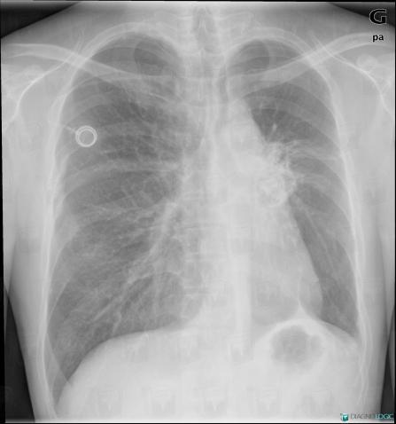 Pneumopathie radique, Parenchyme pulmonaire, Hile pulmonaire, Radio