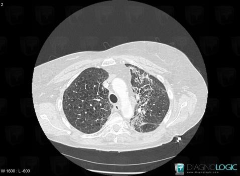 Pneumopathie radique, Parenchyme pulmonaire, Scanner