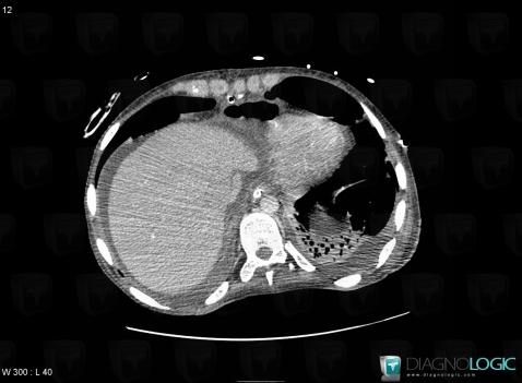 Pneumopericardium, Cardiac cavities / Pericardium, CT