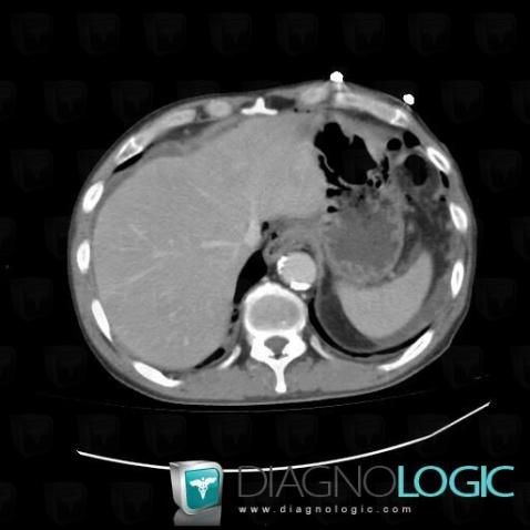 Pneumoperitoneum, Mesentery / Peritoneum, CT