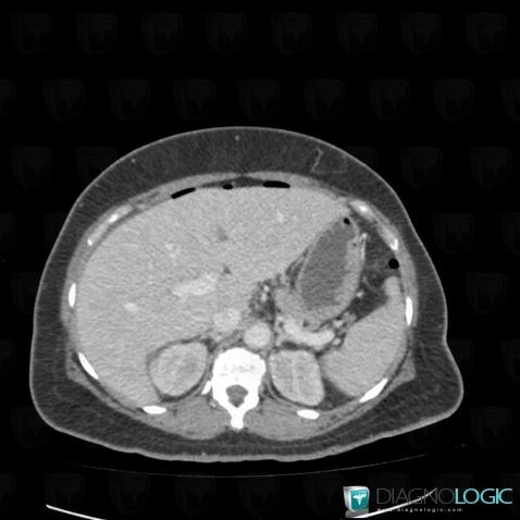Pneumoperitoneum, Mesentery / Peritoneum, CT