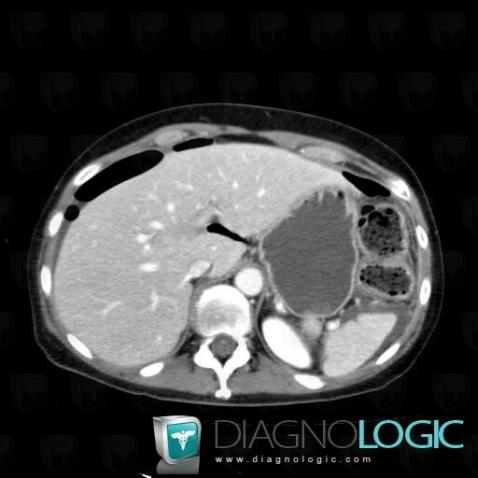 Pneumoperitoneum, Mesentery / Peritoneum, CT