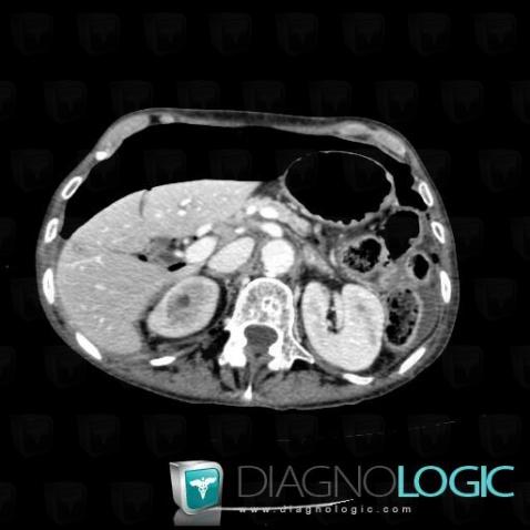 Pneumoperitoneum, Mesentery / Peritoneum, CT