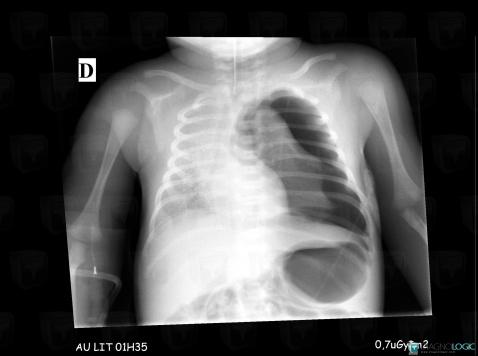 Pneumothorax, Hile pulmonaire, Médiastin, Radio