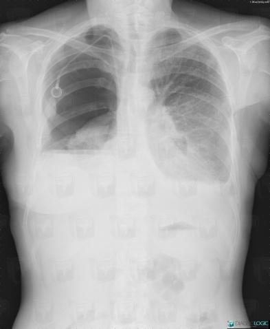 Pneumothorax, Parenchyme pulmonaire, Plèvre, Radio