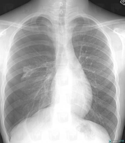 Pneumothorax, Parenchyme pulmonaire, Radio