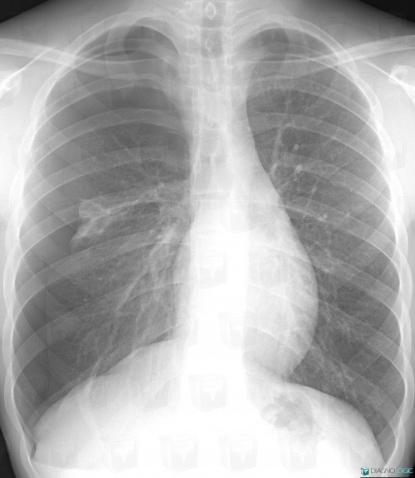 Pneumothorax, Parenchyme pulmonaire, Radio