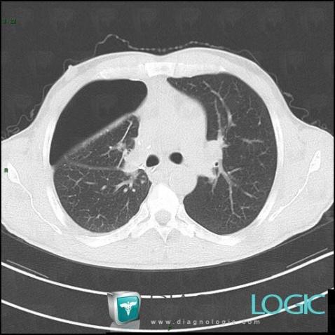 Pneumothorax, Pleura, CT