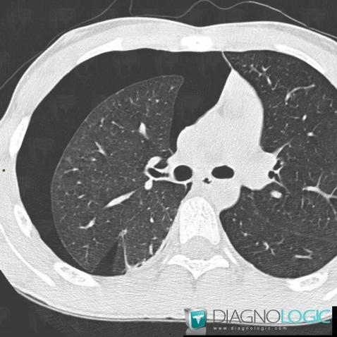 Pneumothorax, Pleura, CT