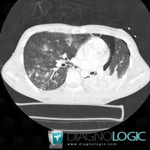 Pneumothorax, Pleura, CT