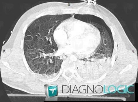 Pneumothorax, Pleura, CT