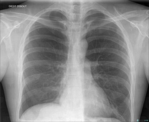 Radiology case : Atelectasis (X rays ,CT) - Diagnologic