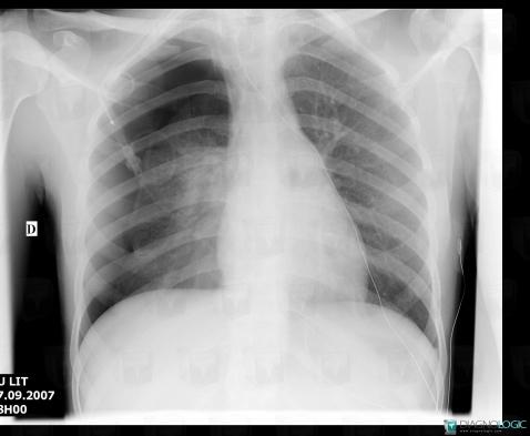 Pneumothorax, Plèvre, Radio