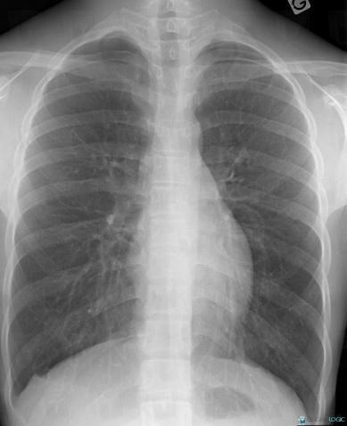 Pneumothorax, Plèvre, Radio