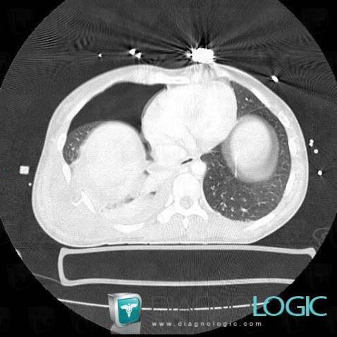Cas radiologie : Lacération (Scanner) - Diagnologic