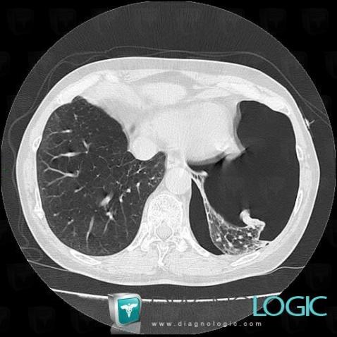 Pneumothorax, Plèvre, Scanner