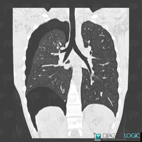 Pneumothorax, Plèvre, Scanner