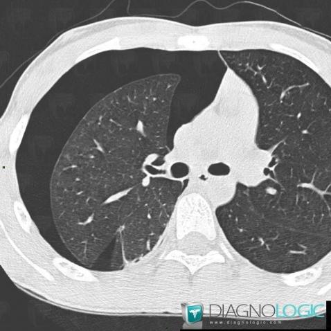 Pneumothorax, Plèvre, Scanner