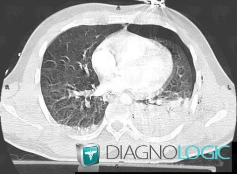 Cas radiologie : Contusion pulmonaire (Scanner) - Diagnologic