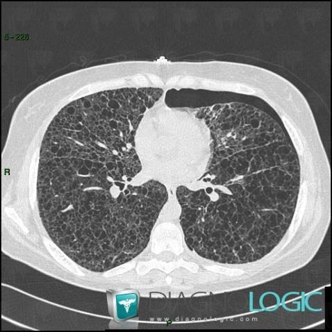 Pneumothorax, Pulmonary parenchyma, CT