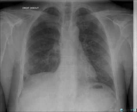 Pneumothorax, Pulmonary parenchyma, X rays