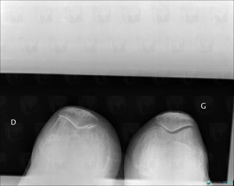 Polyarthrite rhumatoïde , Articulation fémoro patellaire, Radio