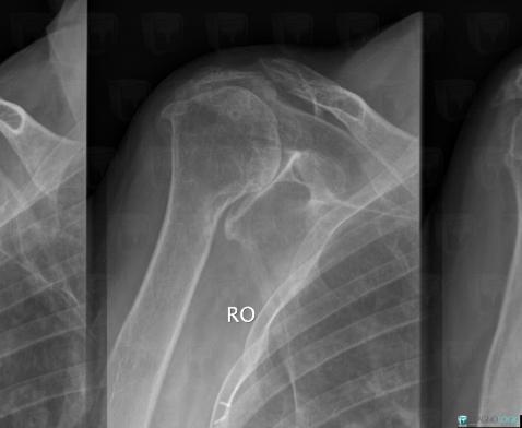 cas-radiologie-polyarthrite-rhumato-de-radio-diagnologic