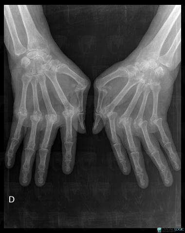 Polyarthrite rhumatoïde , Articulations radio carpiennes, Articulations métacarpo phalangiennes, Radio