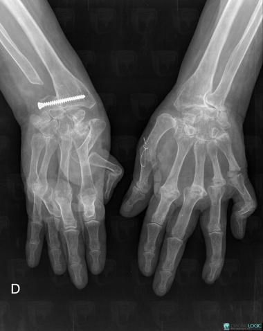 cas-radiologie-polyarthrite-rhumato-de-radio-diagnologic