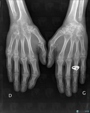 Polyarthrite rhumatoïde , Ulna -inférieur, Autres os-carpe, Radio