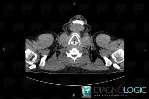 Polychondrite atrophiante, Larynx, Scanner