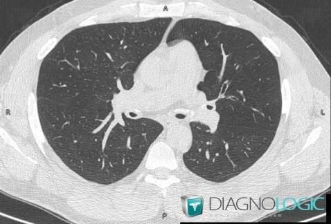 Polychondrite atrophiante, Parenchyme pulmonaire, Scanner