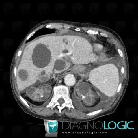 Polycystic kidney disease, Kidney, CT