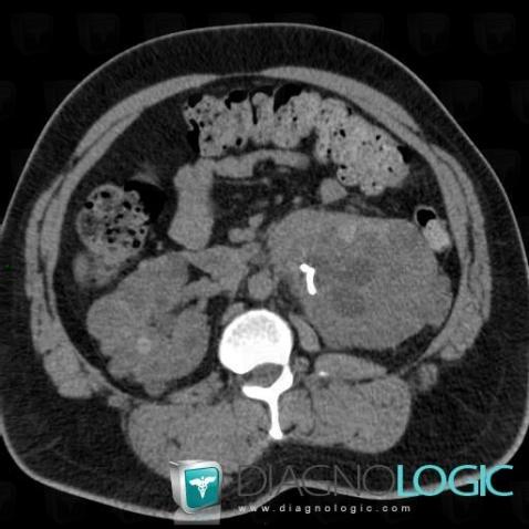 Polycystic kidney disease, Kidney, CT