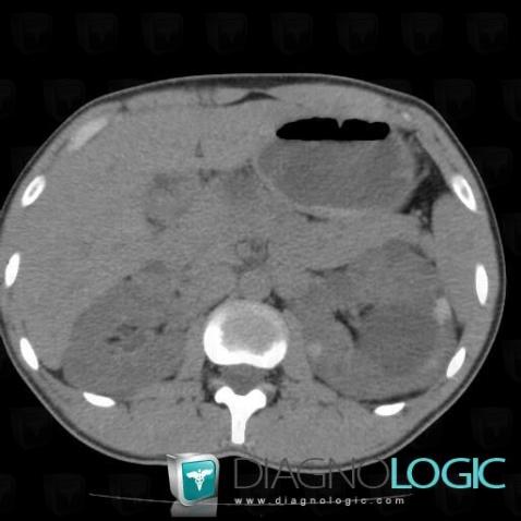 Polycystic kidney disease, Kidney, CT