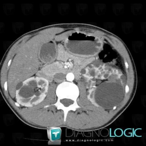 Polycystic kidney disease, Kidney, CT