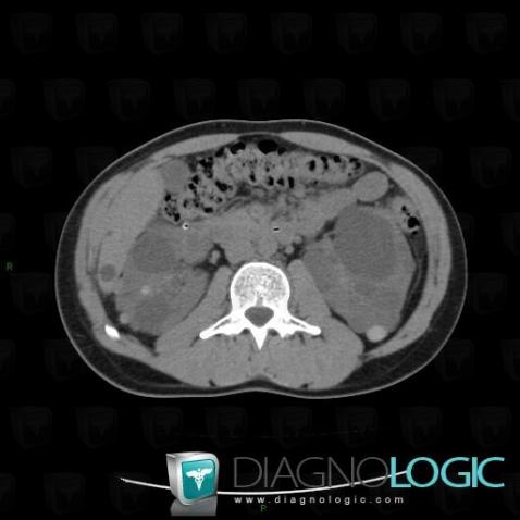 Polycystic kidney disease, Kidney, CT