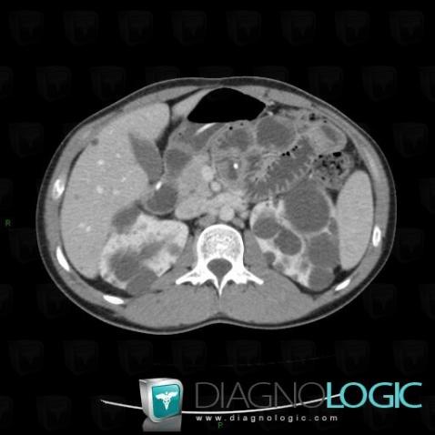 Polycystic kidney disease, Kidney, CT