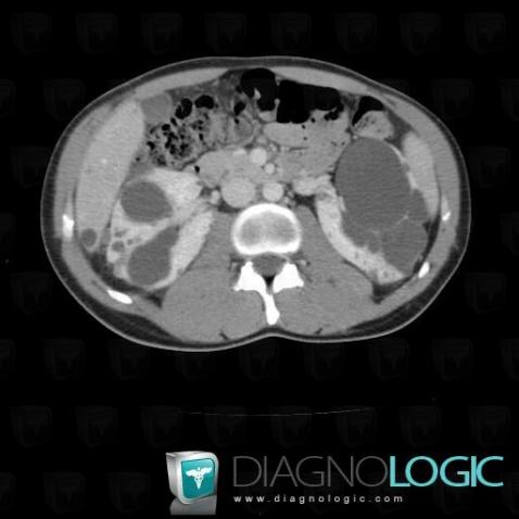 Polycystic kidney disease, Kidney, CT