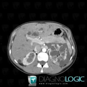 Polycystic kidney disease, Kidney, CT